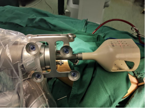 骨科机器人手术“精准到毫米”